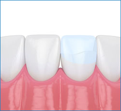 dental bonding procedure