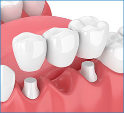 dental bridge