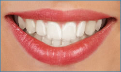 clear aligners braces