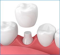 dental crowns