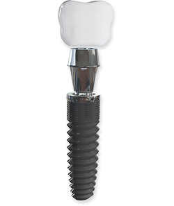 dental implants dentist kenilworth