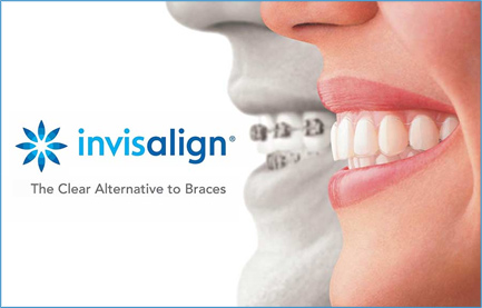 invisalign issaquah