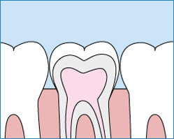 dental sealants