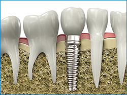 single implant kenilworth