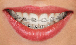 traditional braces