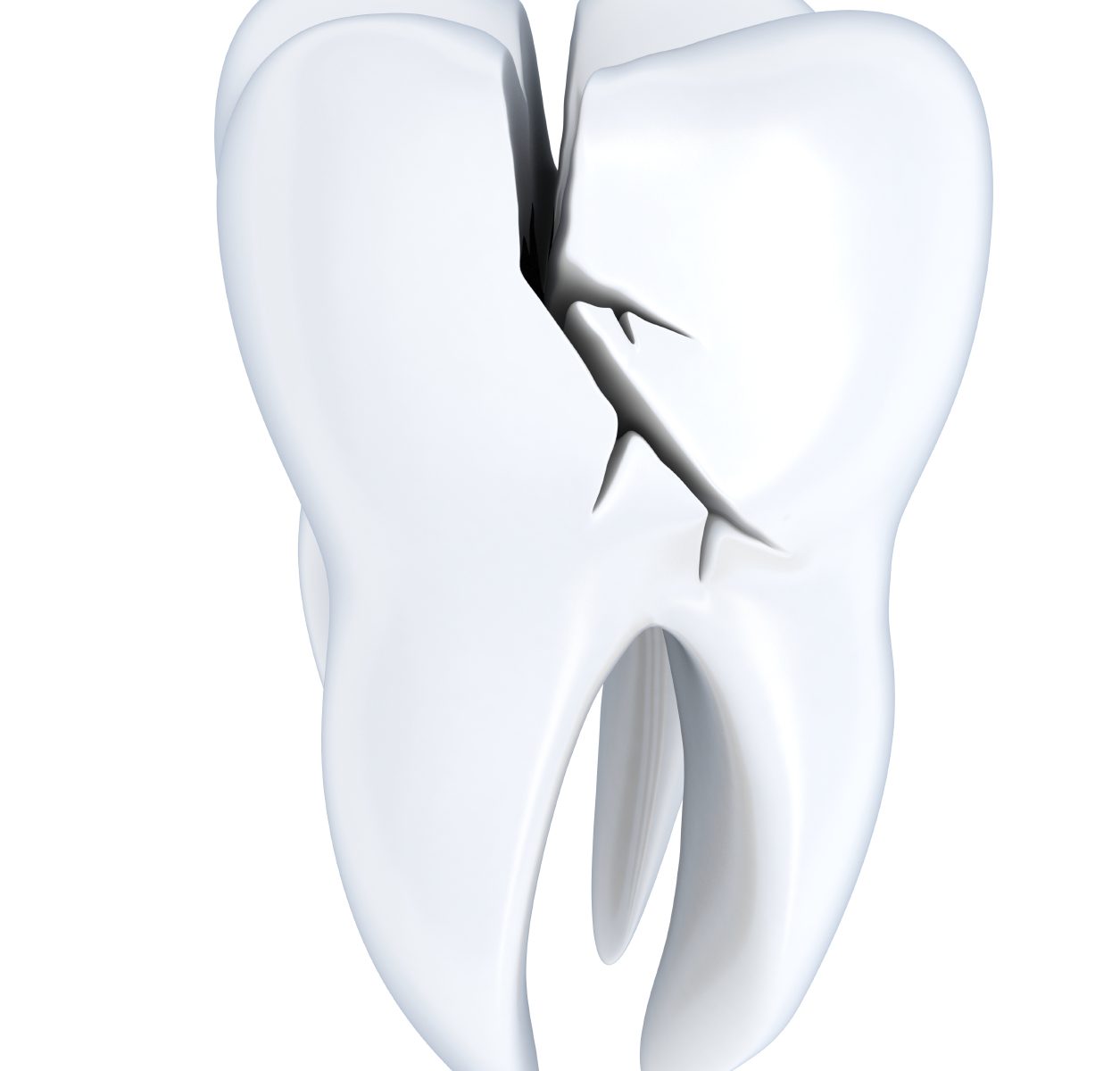a cracked tooth to show that dental trauma and cracked teeth can happen to anyone